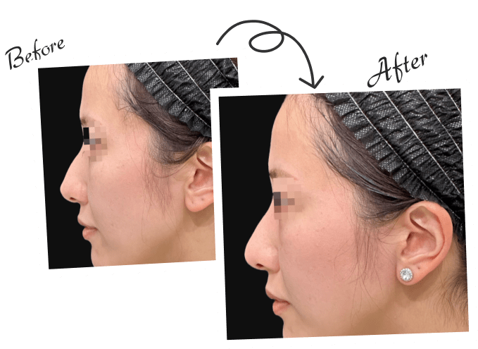 鼻整形 before&after